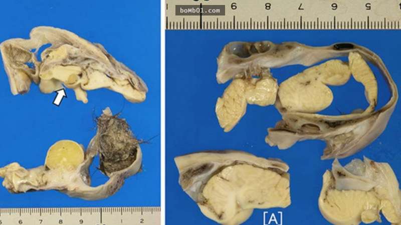 16歲少女動盲腸手術竟在腹中發現「微型腦」，最恐怖的是腦袋還能正常運作…