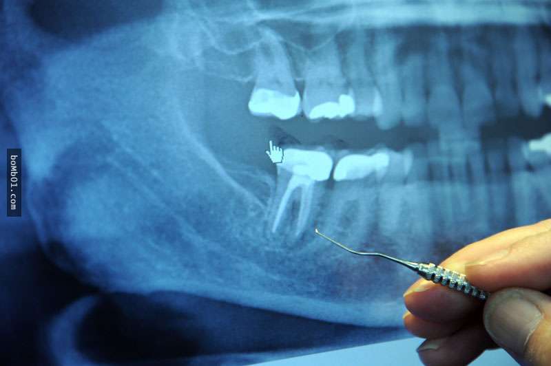 科學家終於找到能「進行自我修復」的補牙材料，從這天開始我們都要和根管治療說掰掰了！