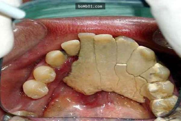牙醫幫患者清除「史上最大的牙結石」，一塊一塊剝落的的畫面簡直太療癒了！