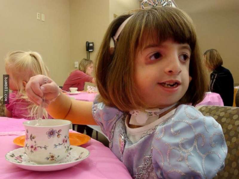 無臉症女孩9歲時終於在頭部動了手術，術後她的「特開心表情」也讓所有人露出大大的笑容了！