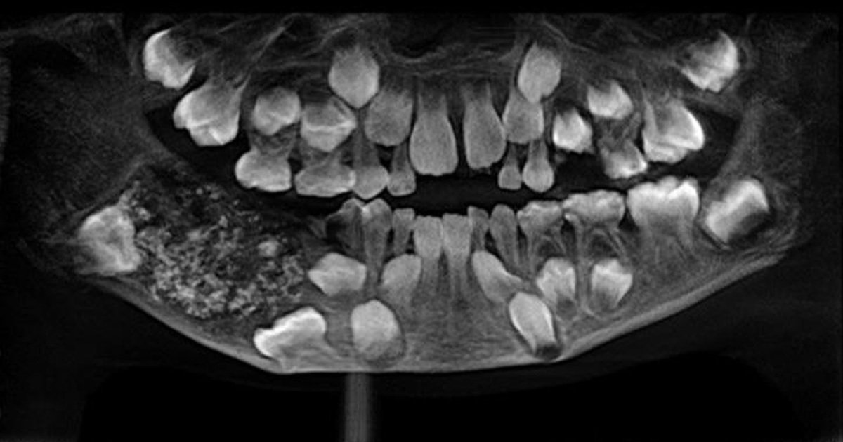 7歲男孩下顎長出「詭異肉包」　醫生一劃...驚見「526顆密集牙齒」