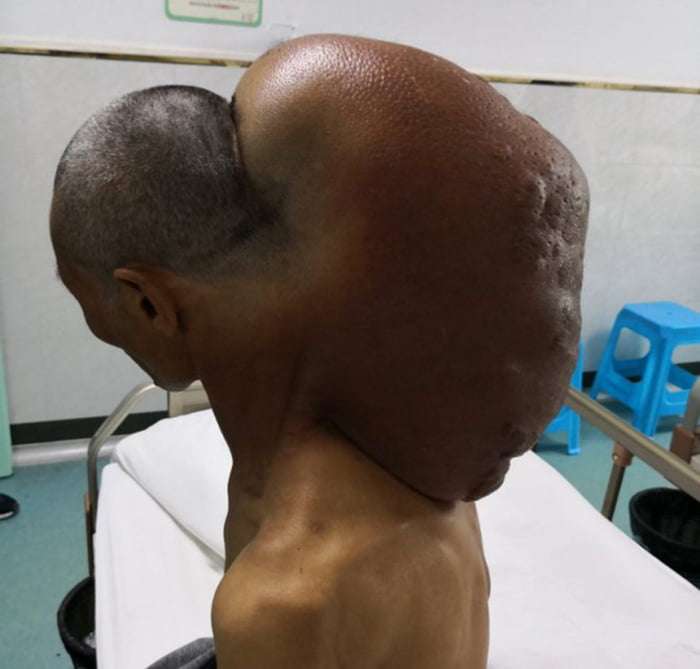 15公斤腫瘤如影隨行47年　醫生花10小時幫他移除「瞬間超不習慣」