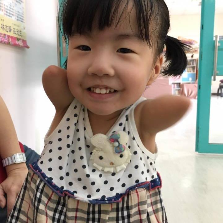 爸爸賣米線照顧「只有一隻左腳」的5歲女兒　她超樂觀面對人生：我不奇怪