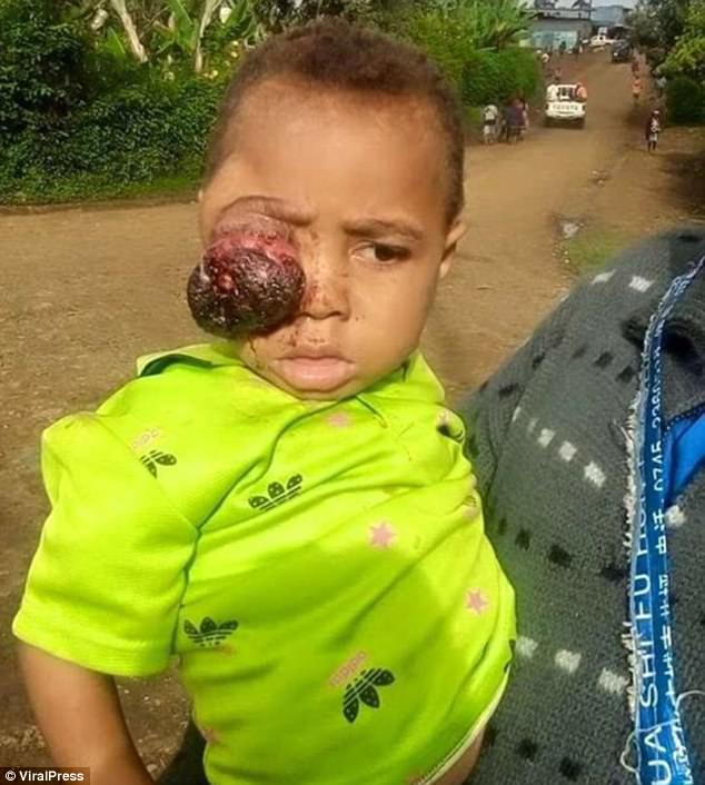 這個3歲小男孩「眼睛被腫瘤吃掉」父母找不到方法救他，結果選擇黑魔法治療造成難以挽回的後果…！