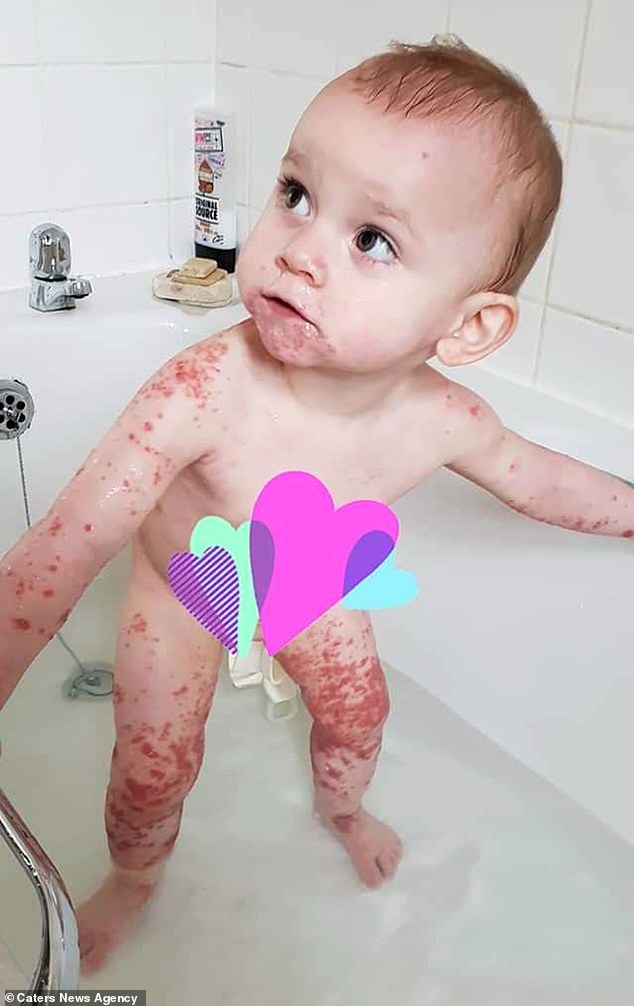 1歲愛女被親一口冒「紫紅色斑點」送急診　醫生示警：親她的人嘴恐有毒