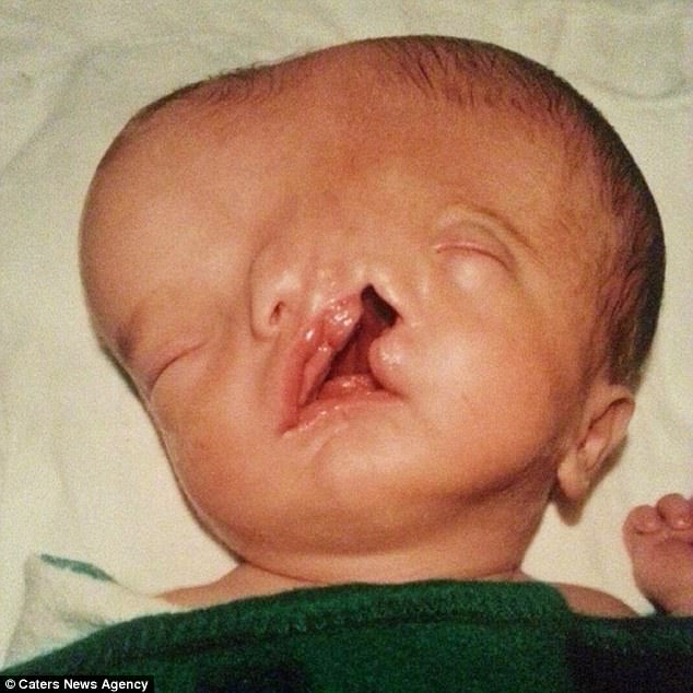 這個出生就有2張臉的寶寶「大家都叫媽媽殺掉他」，如今他證明了媽媽當年堅持養大他是最正確的決定！