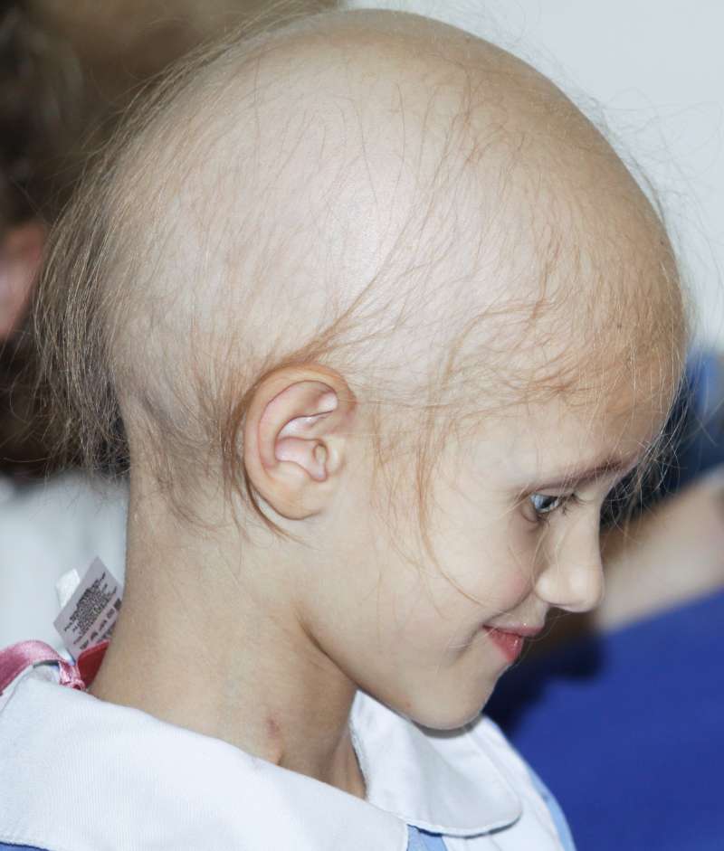 13歲全禿少女「吃新藥長出頭髮」　醫生也訝異：禿頭人士有救了