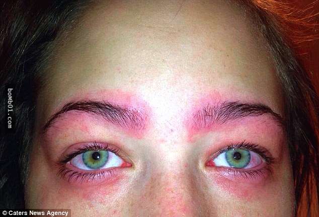 16歲女生「嘗試自己染髮」結果發生過敏反應，接著眼睛的狀況害她差點就變成瞎子！