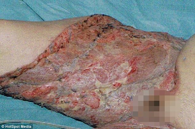 英國人妻拿剃刀「刮除私密處毛髮」後突然休克昏迷，9天後醒來發現自己的大腿已經變「黑色腐肉」！