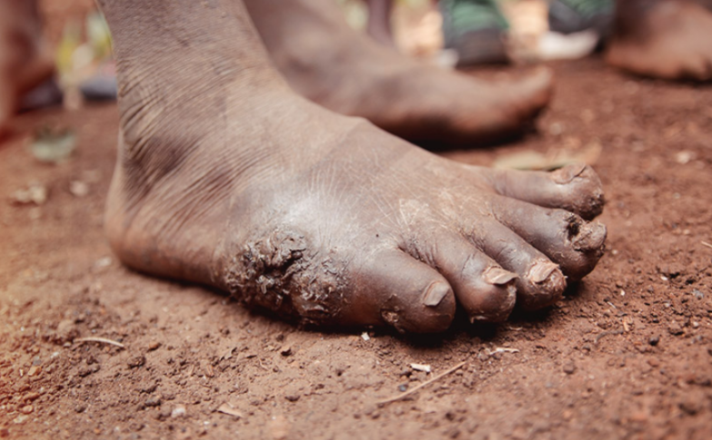 現在去超商就能「送舊鞋到非洲」　你一個動作可以幫他們遠離沙蚤、寄生蟲