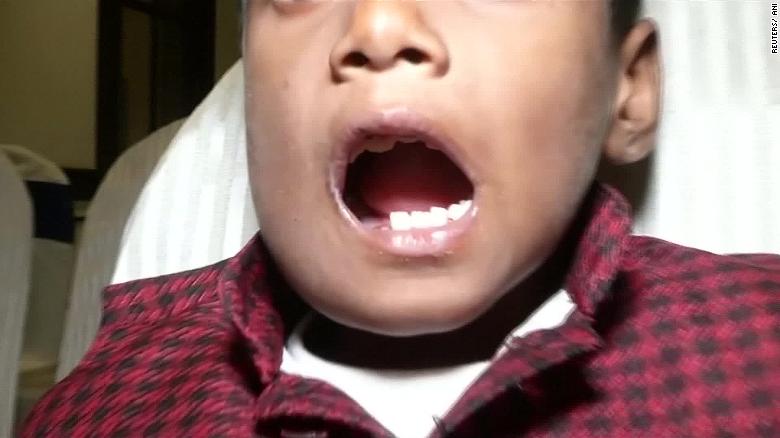 7歲男孩下顎長出「詭異肉包」　醫生一劃...驚見「526顆密集牙齒」