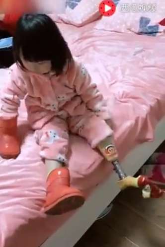 小女孩每天起床第一件事「自己裝義肢」　3歲就必須習慣的日常太催淚
