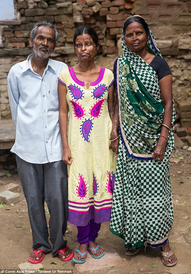印度母女被丈夫潑酸後「失明破相」，但她們現在卻「回到兇手身邊」繼續同住了…