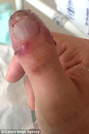 英國媽媽忽略弄掉美甲時不小心造成的傷口，幾天後手指「快爛掉」才嚇到緊急就醫