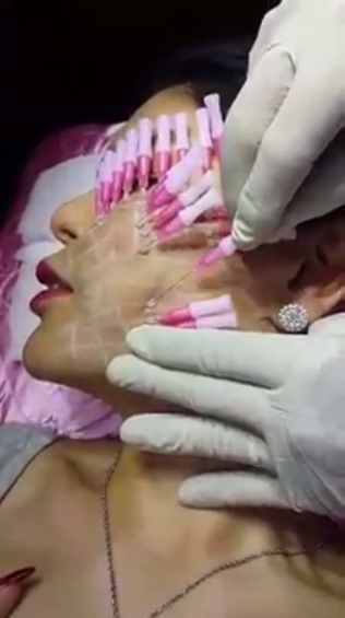 美女公開「V字臉埋線拉提手術」驚悚影片，「臉插28根長針」光是用看的就快被痛死了！