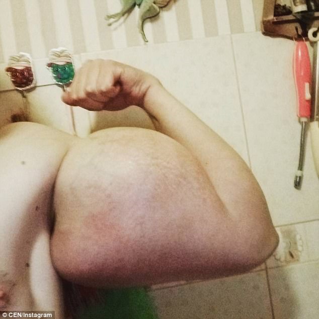 21歲俄男為了有「大肌肌」瘋狂注射化學物質，醫生驚「那會害你死掉」…他還想繼續注射！