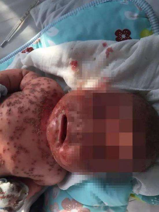 嬰兒被大人亂親的後果！　「皰疹病毒」害小寶寶全身爛掉　請停止這樣做