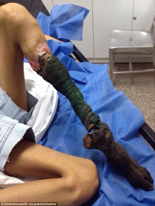 慎入！13歲女孩被毒蛇咬傷接受「土法治療」　腿部竟然只剩下「枯黑腐爛骨頭」
