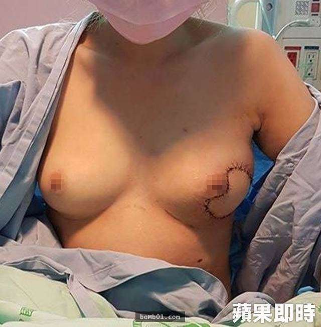 台中女子只因「小時候出過車禍」長大後竟然乳房潰爛，34D巨乳現在半個乳房被挖掉！