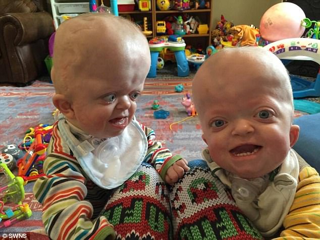 58歲阿嬤無私照顧沒有血緣關係的畸形雙胞胎，看了他們露出的笑容大家都秒懂她的偉大！