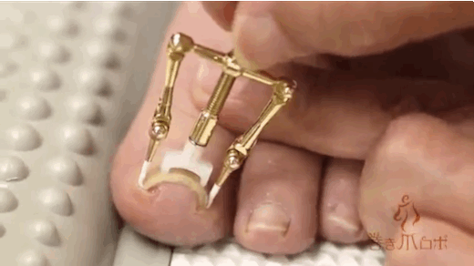 指甲內嵌可以自己救　日本製神物讓網狂讚：光看就好舒壓