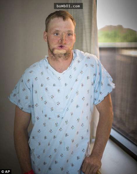 這個自殺不遂結果整張臉都毀掉的男子，10年後醫生居然幫他「把五官都修回來了」！