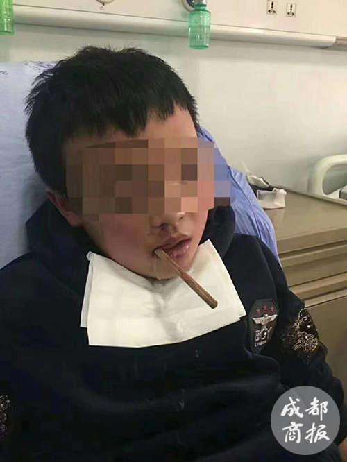 筷子插進喉嚨10.5公分！　10歲男童邊吃飯邊玩　一不小心滑倒父母被嚇傻