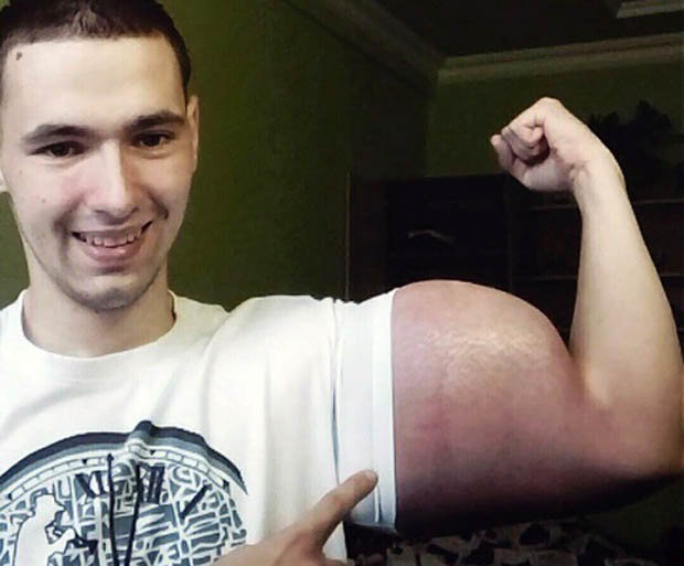 21歲俄羅斯男瘋了「把6升油注入手臂」變大力水手，醫生吃驚：不截肢就會死