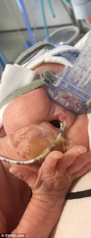 這個手掌寶寶在墮胎期限之前趕著出生，「連內臟都還可以看到」的他現在的狀況連醫生也直呼是奇蹟！