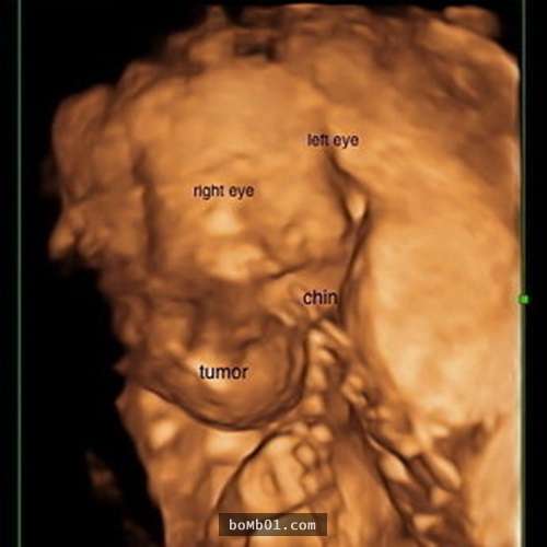 母親在寶寶6個月大時選擇了強制墮胎，但等到寶寶出生後…她的臉讓他們都震驚到說不出話！