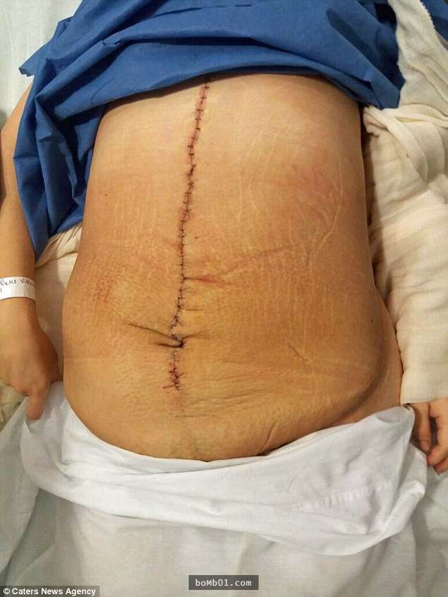 這名女子腹部長出「破紀錄的巨大腫塊」，31公斤的重量等於懷了「10胞胎」！