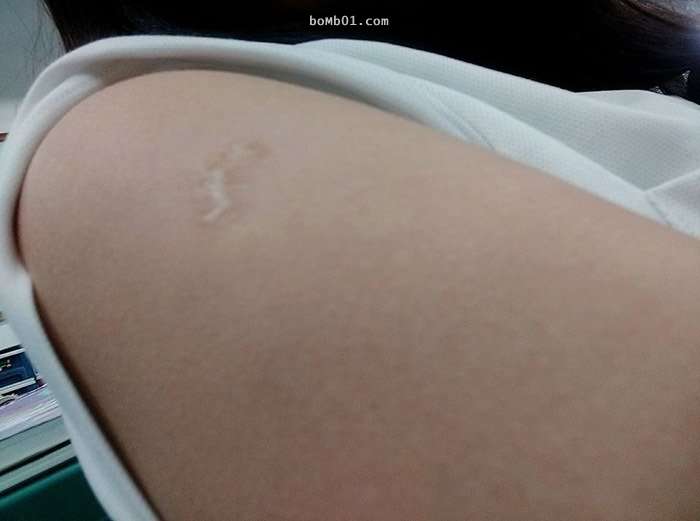 快檢查看看手臂上有沒有「卡介苗疤」，如果沒有的話你就是超稀少的幸運兒體質！