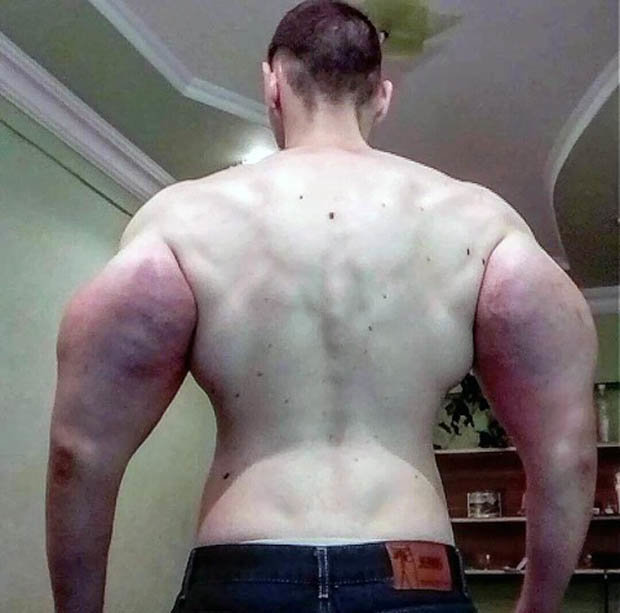 21歲俄羅斯男瘋了「把6升油注入手臂」變大力水手，醫生吃驚：不截肢就會死