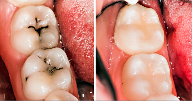 牙齒蛀爛才看醫生？　8個「天然護理方法」助你長保口腔健康