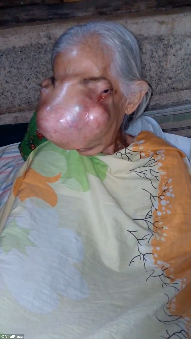 71歲老人罹患「鼻竇炎」卻越來越可怕，最後「臉骨碎裂」家人都不忍直視…