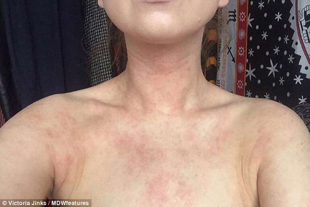 濕疹困擾她20多年　吃素後「奇蹟治癒」皮膚變超光滑