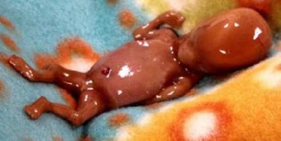 婦產科護士分享那些在墮胎手術「倖存」的嬰兒，沒有死掉的他們…其實比死亡更慘！