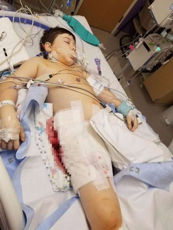 8歲男童騎腳踏車摔倒「縫了傷口」　但8天後「傷口反噬」把他右半邊身體都吃掉了
