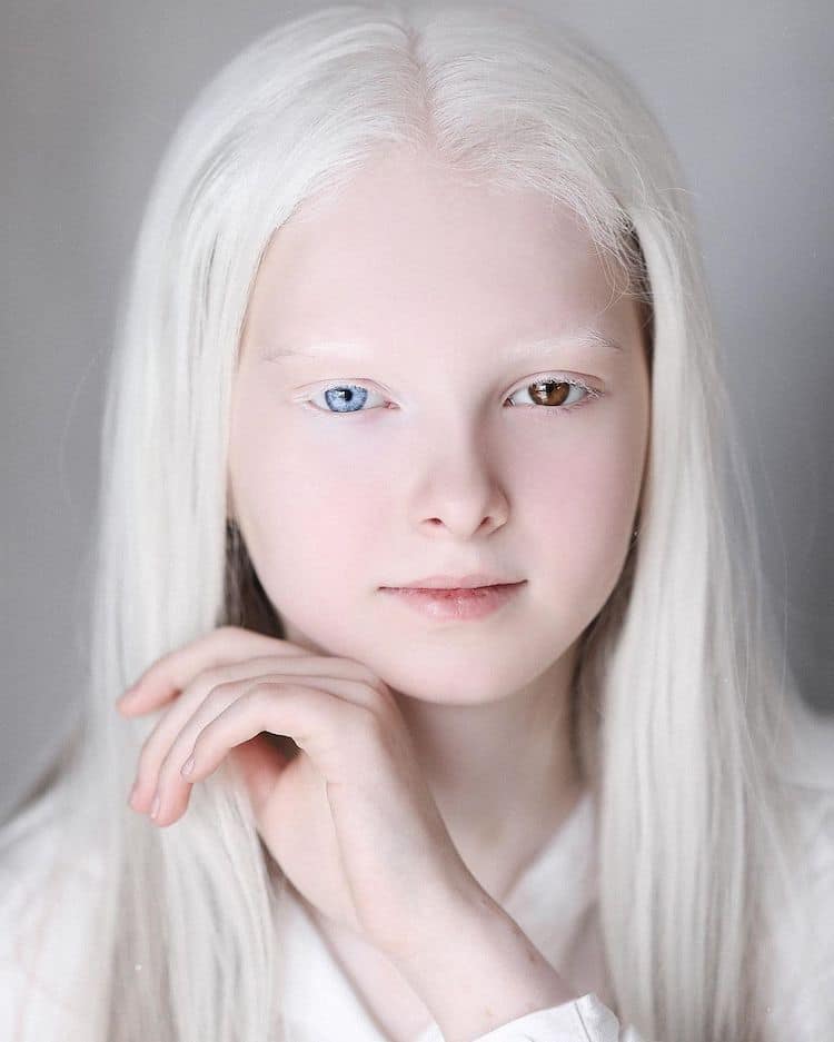 人間有天使！白化女孩獨有「藍褐異色瞳」　睜開「眼底藏星空」越看越吸引人❤️