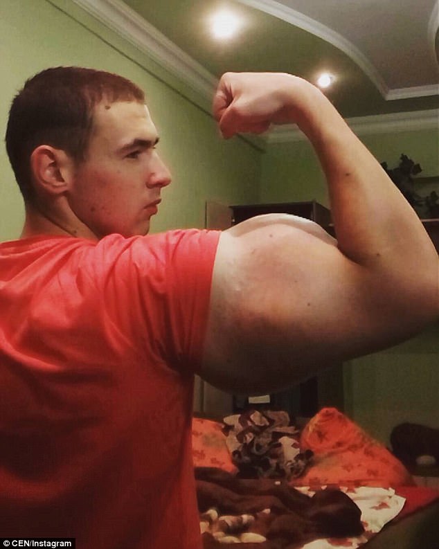 21歲俄男為了有「大肌肌」瘋狂注射化學物質，醫生驚「那會害你死掉」…他還想繼續注射！