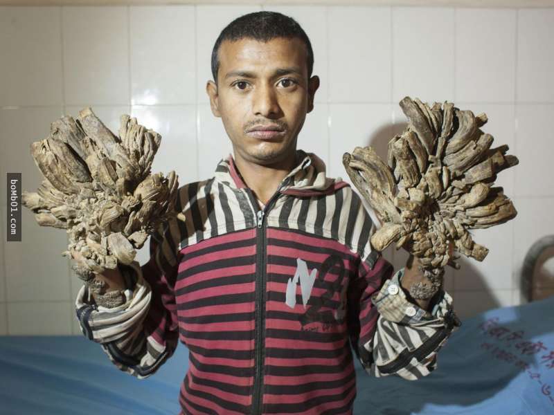 孟加拉「樹人」經過16次手術終於割掉11公斤的疣，他現在的手長這樣…