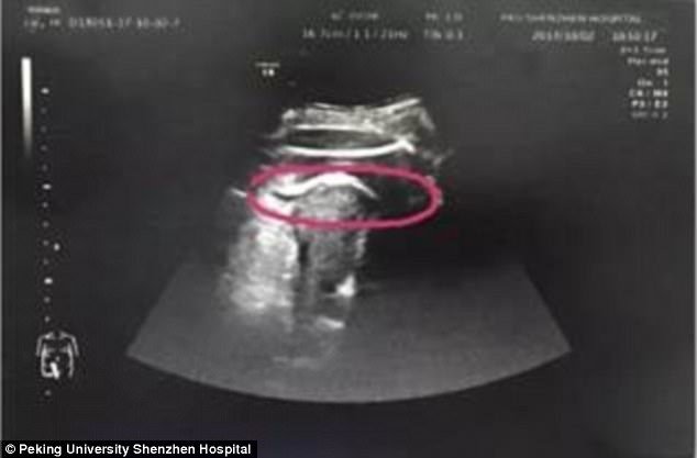 媽媽險死！8個月胎兒在肚子裡使出「無影腳」把子宮踢破，醫師檢查後趕緊在10分內把寶寶取出來！