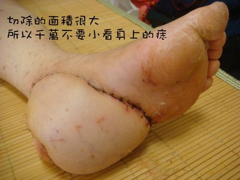 醫生一看女病人的腳上出現「連線衛星痣」，馬上幫她轉到大醫院「後腳跟被切掉10CM、再切大腿肉…」！