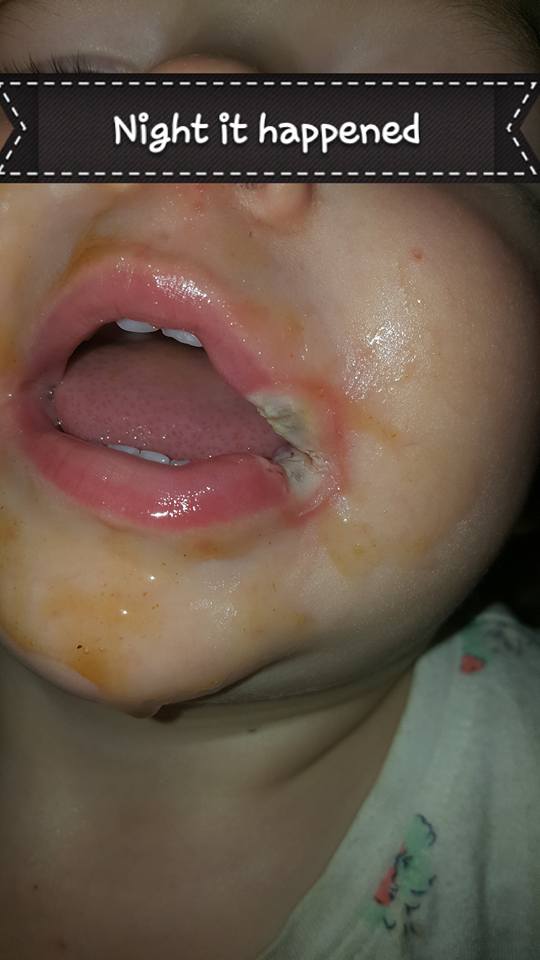 媽媽PO照警告！19個月大女兒「只是舔了手機充電器」，她當晚就無助的看著女兒嘴角潰爛！