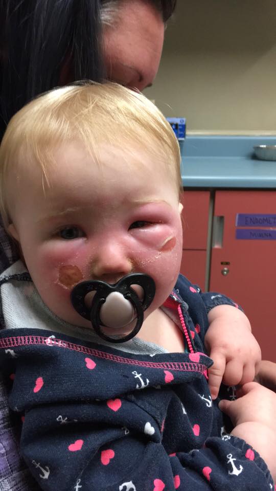 這個媽媽沒注意幫14個月大女兒擦了「這個產品」，隔天看到女兒竟然發現她已經嚴重灼傷！