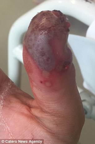 英國媽媽忽略弄掉美甲時不小心造成的傷口，幾天後手指「快爛掉」才嚇到緊急就醫
