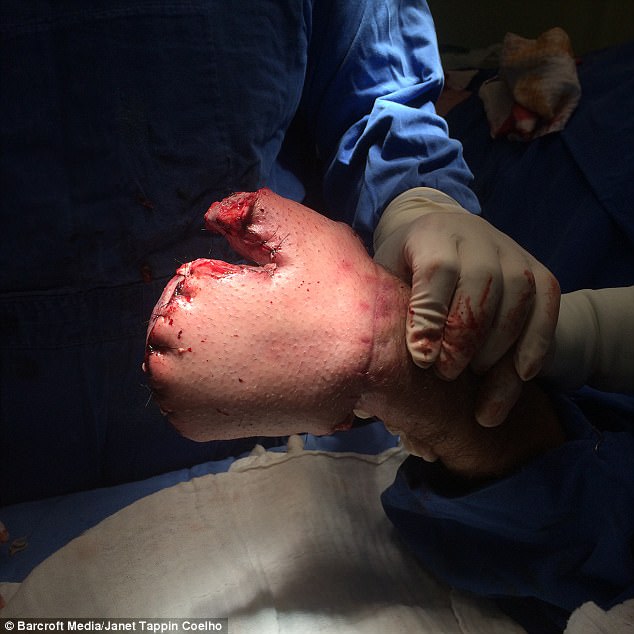 這個工人的手掌整隻斷掉後「醫生直接把手縫進肚子裡」，現在拿出來一看大家都不敢相信會變那樣！