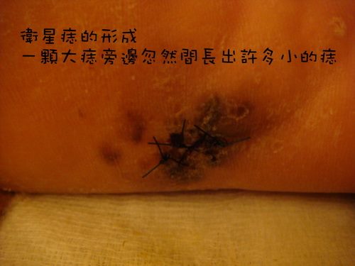 醫生一看女病人的腳上出現「連線衛星痣」，馬上幫她轉到大醫院「後腳跟被切掉10CM、再切大腿肉…」！
