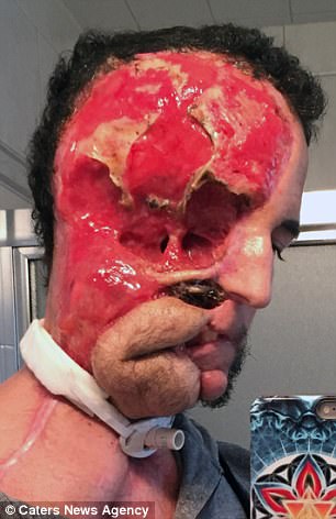38歲帥哥某天下巴痛「之後左臉就被全部吞噬」，3年後家人都不敢相信他會長這樣…
