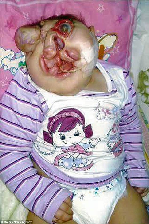 「無臉女孩」一出生醫師認為她很快會死掉，但家人的愛卻創造奇蹟讓她活到現在已經9歲生日！
